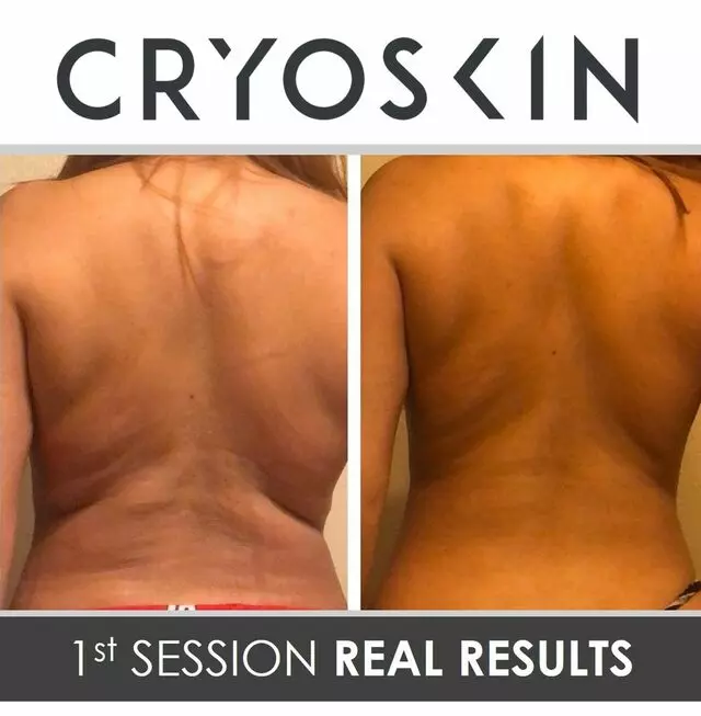 Indiana CRYO