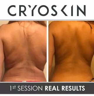 Indiana CRYO